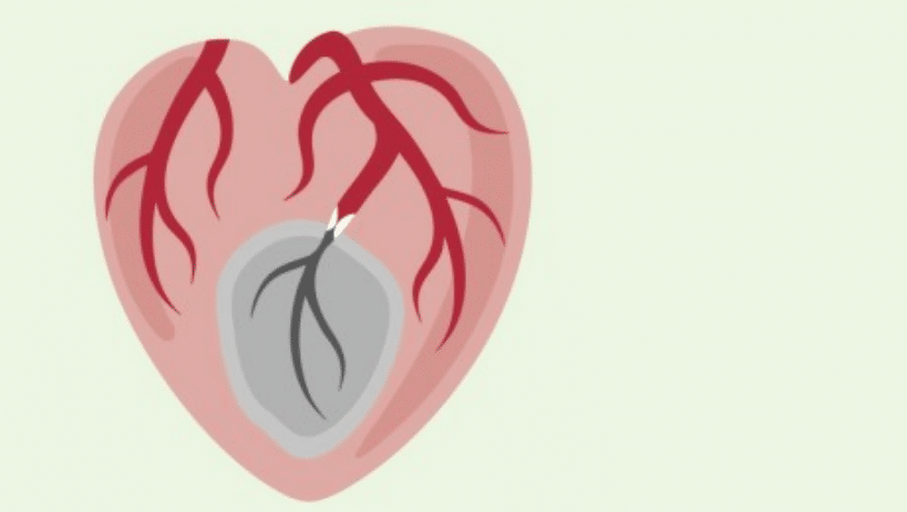 Gesunde Gefäße - gesundes Herz. Den Herzinfarkt vermeiden